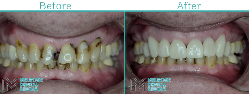 Smile makeover with porcelain veneers at Melrose Dental Studio, before and after, case 6